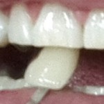 Bottom thing is a model tooth that shows my starting color.